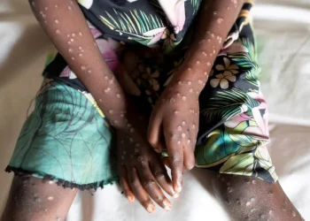 Ghana heightens surveillance to combat Mpox disease