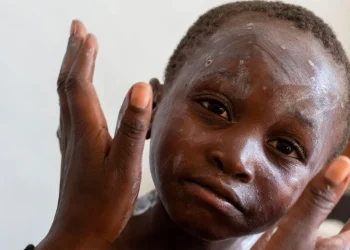 How worried should we be about mpox?