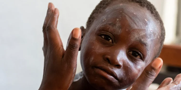 How worried should we be about mpox?