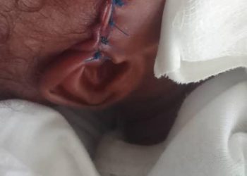 Newborn reportedly injured during cesarean section at Jasikan district hospital