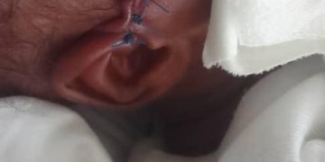 Newborn reportedly injured during cesarean section at Jasikan district hospital