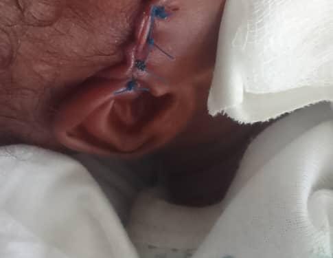 Newborn reportedly injured during cesarean section at Jasikan district hospital