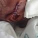 Newborn reportedly injured during cesarean section at Jasikan district hospital