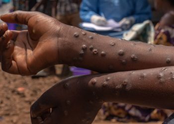 6 new Mpox cases, recorded in Ghana, total confirmed infections now 1,070 since outbreak