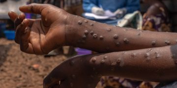 6 new Mpox cases, recorded in Ghana, total confirmed infections now 1,070 since outbreak