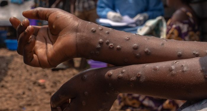 6 new Mpox cases, recorded in Ghana, total confirmed infections now 1,070 since outbreak