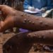 6 new Mpox cases, recorded in Ghana, total confirmed infections now 1,070 since outbreak